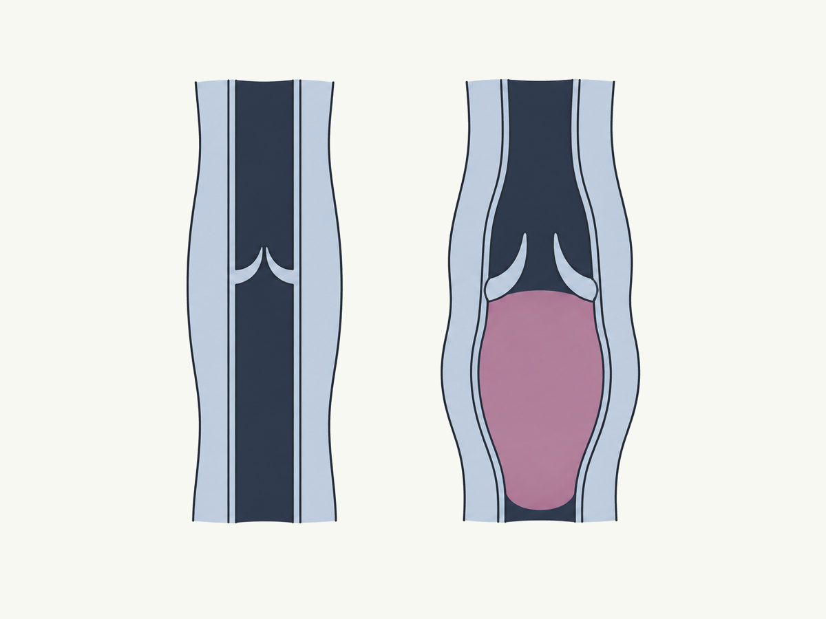 Drawing of a healthy vein valve beside a weak valve with the vein swollen below.