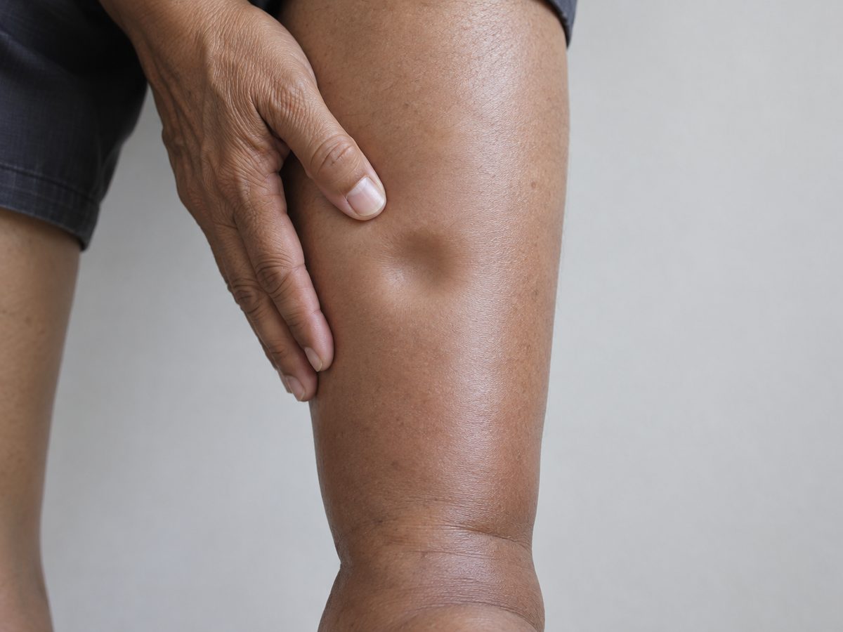 A shallow dent left in a swollen shin after pressing with a thumb.