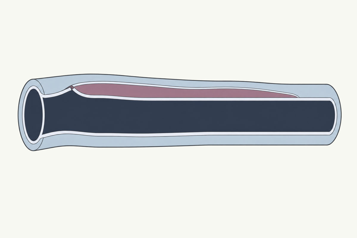 Drawing, not to scale: a section of the aorta cut open along its length, with a tear in its inner layer and a second channel inside the wall