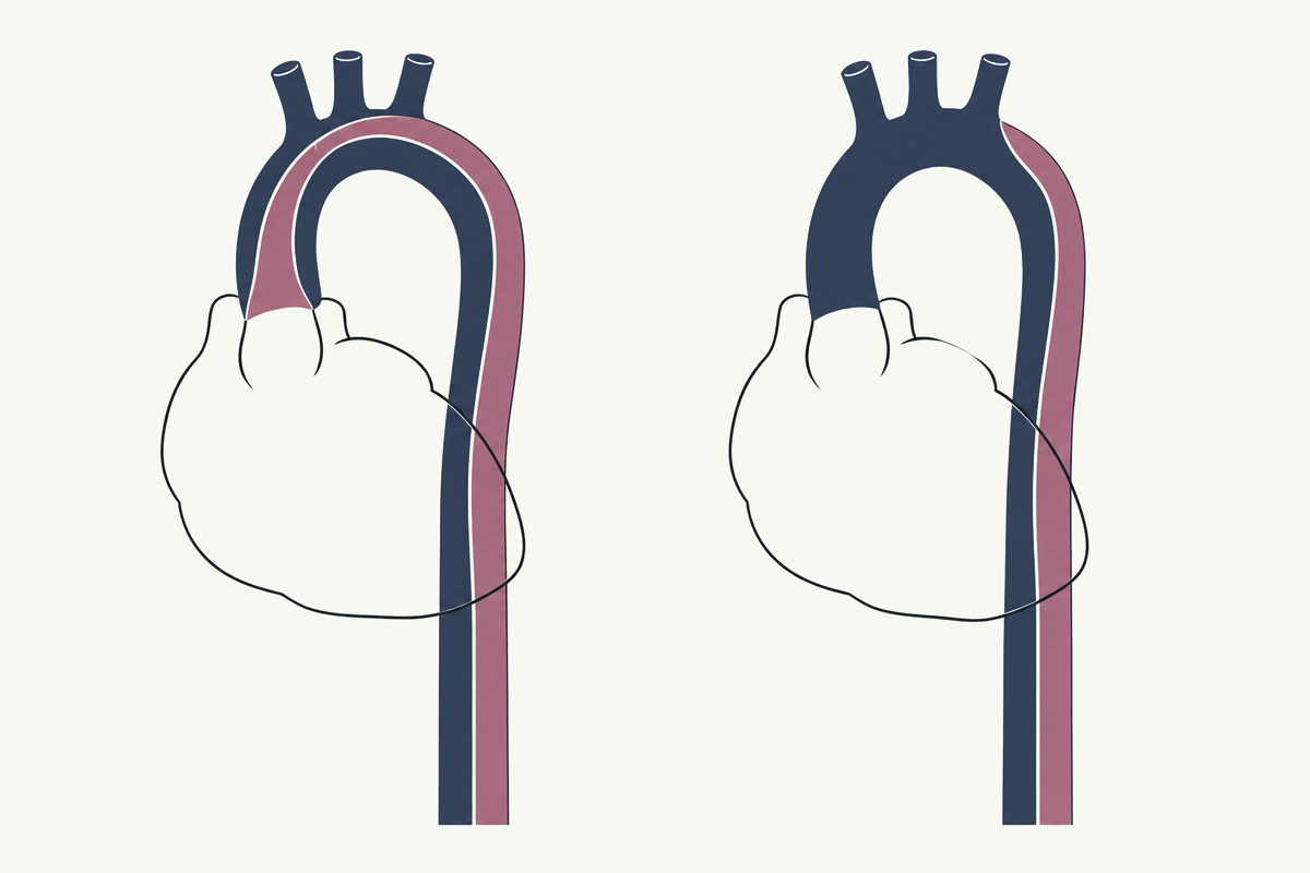 Drawing, not to scale: two aortas side by side, each split by a torn inner layer into two channels; on the left the tear starts just above the heart, on the right only beyond the arch