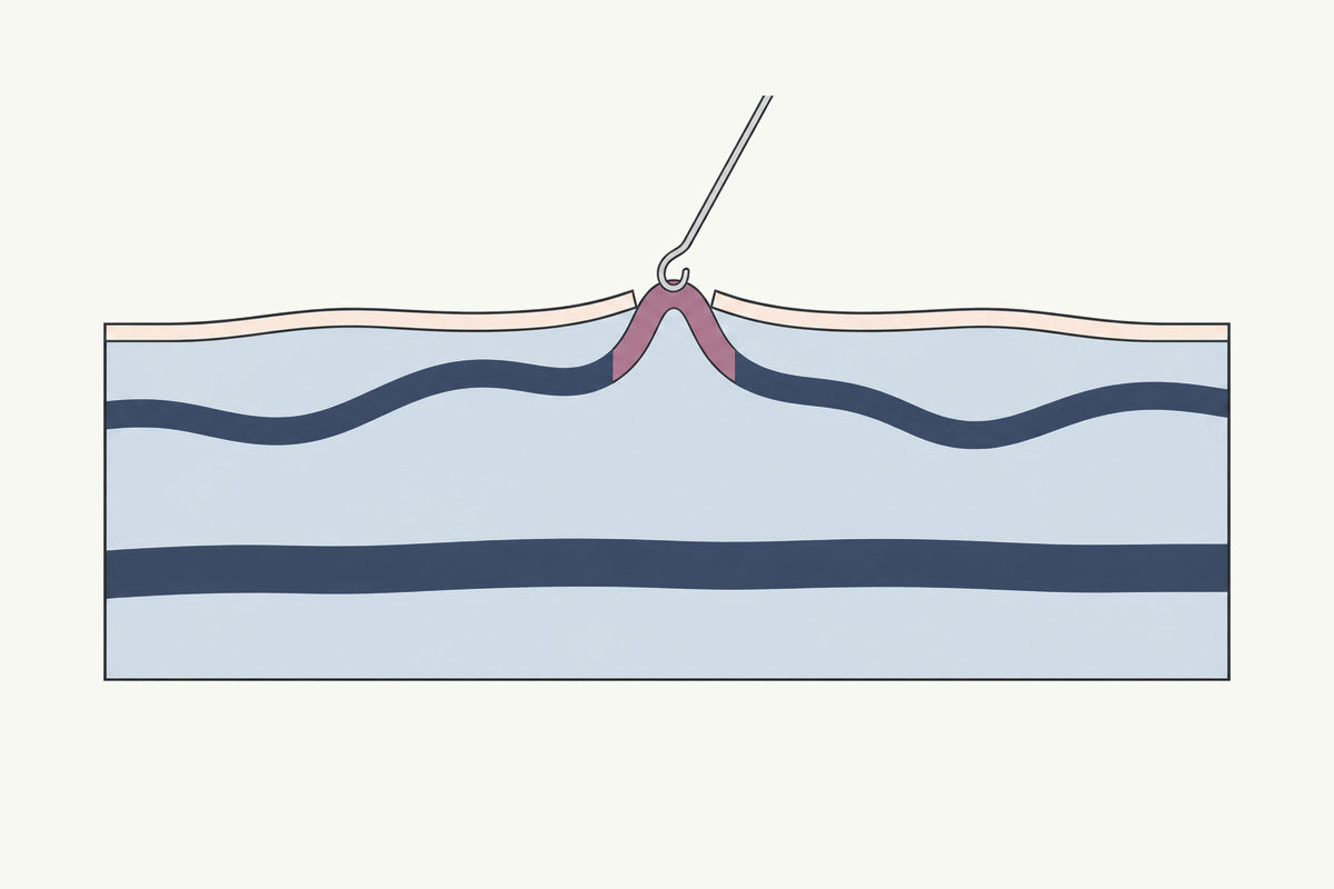 Drawing, not to scale: a fine hook lifting a short loop of a surface vein through a tiny opening in the skin