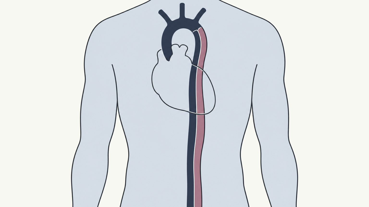 Drawing, not to scale: the aorta in the chest, its inner layer torn just beyond the arch and a second, false channel running down inside its wall