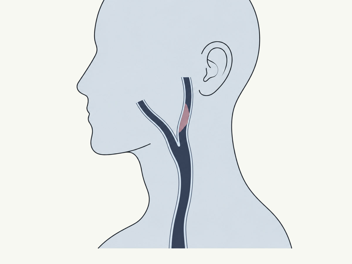 Drawing, not to scale: the carotid artery in the neck, narrowed by plaque where it divides