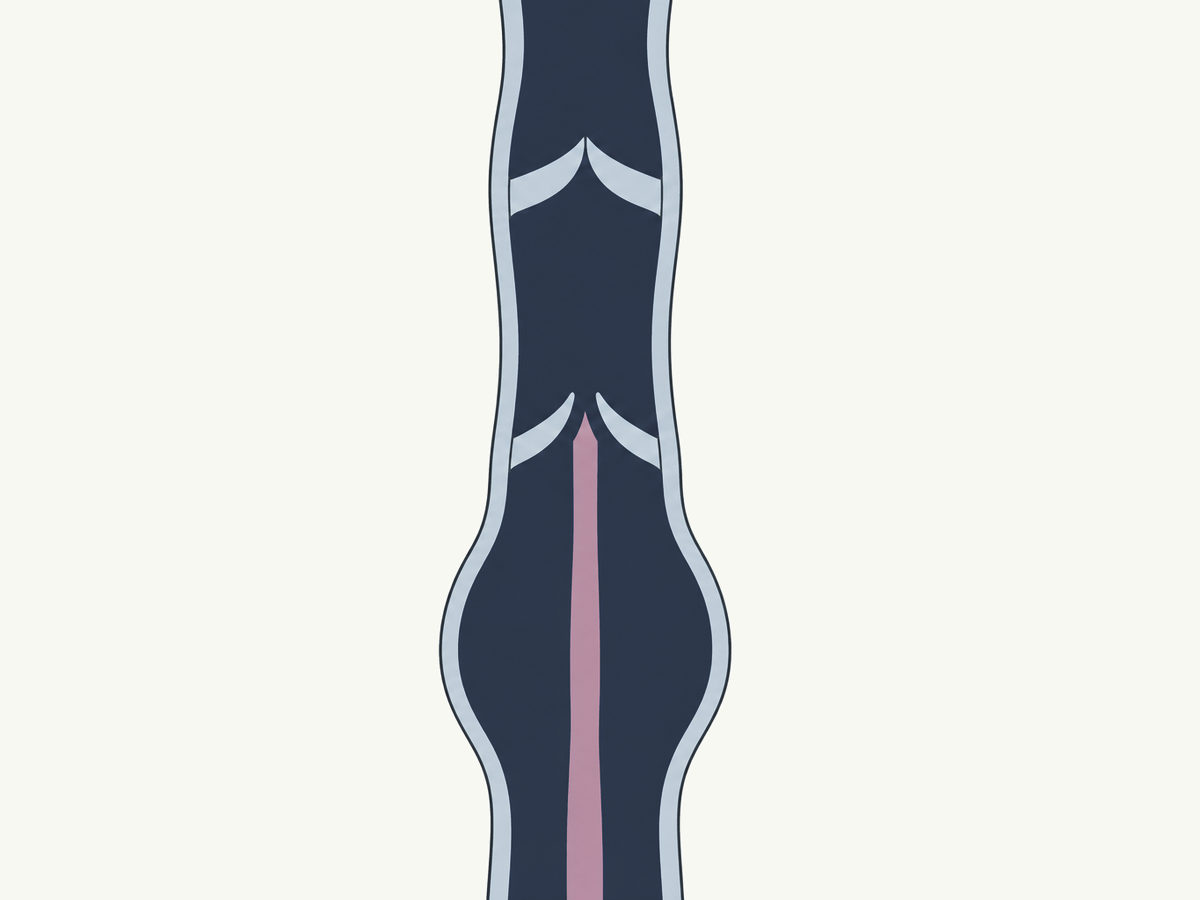 Drawing, not to scale: a vein valve that no longer closes, the vein widened below