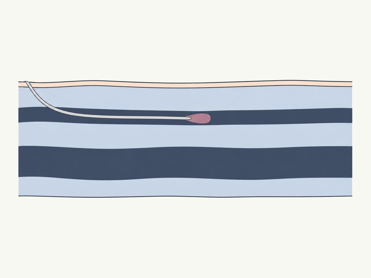 A small amount of medical adhesive leaving the tip of a catheter inside a leg vein