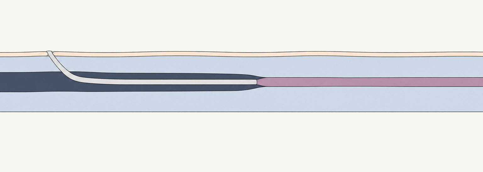 Diagram of a thin catheter sealing a leg vein with medical adhesive