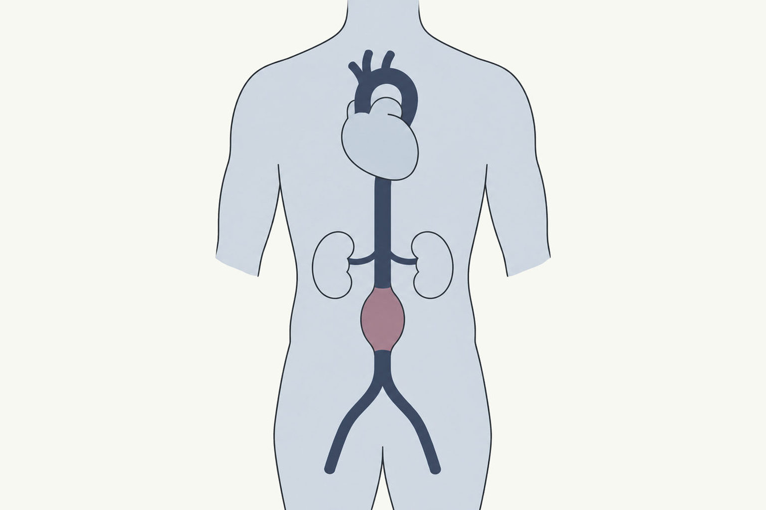 Drawing of the aorta from the heart to the belly, with one widened section below the kidneys