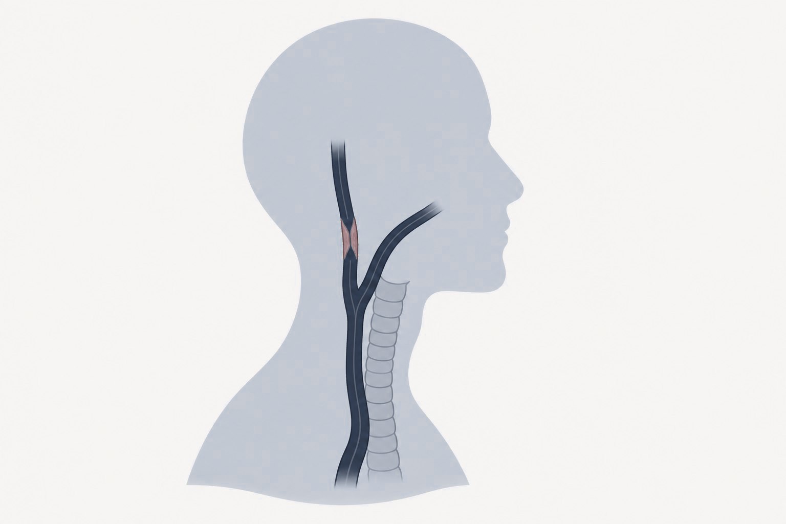 The carotid artery in the neck with a narrowed section