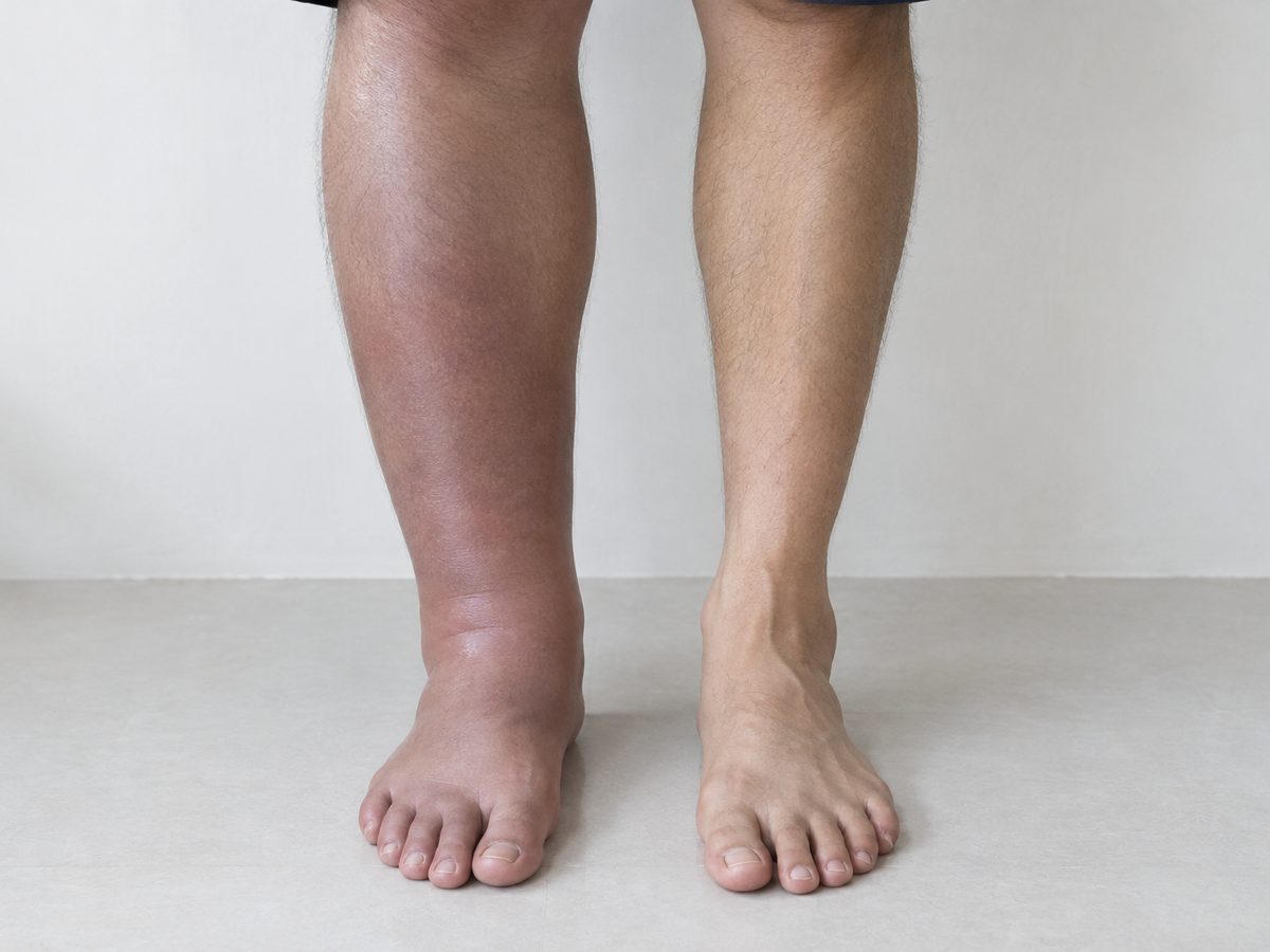 Two lower legs side by side, one swollen and a darker red from the ankle to below the knee