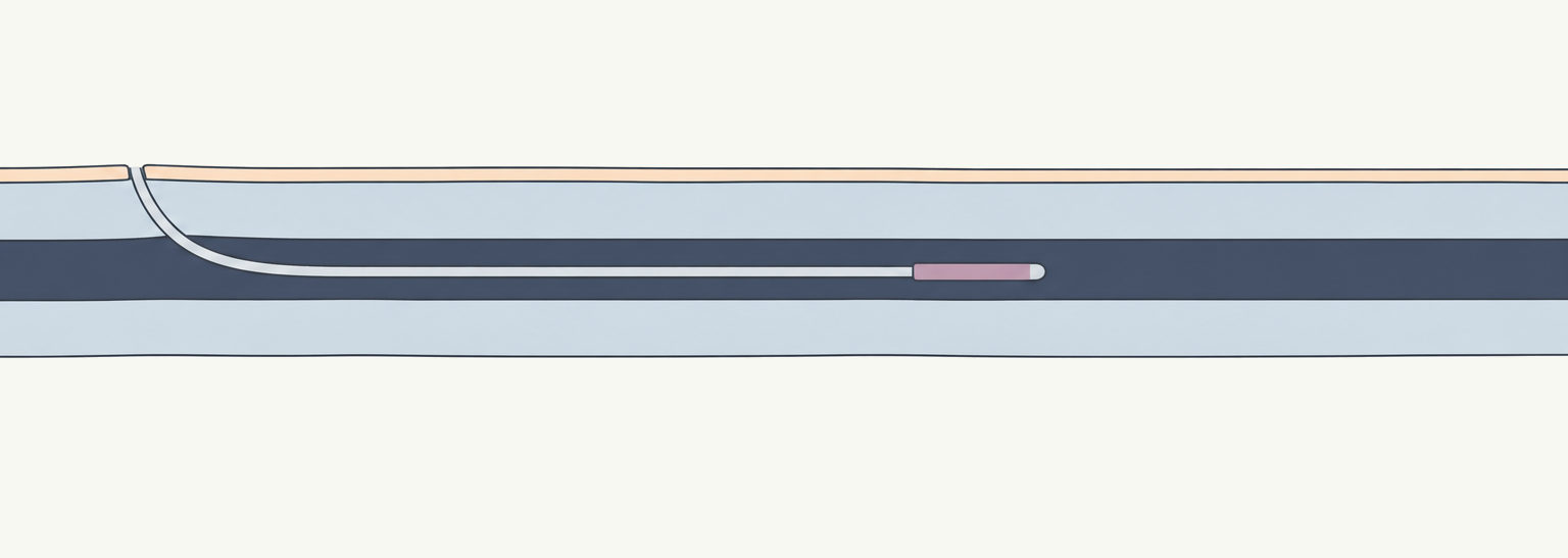 Diagram of a radiofrequency catheter inside a leg vein
