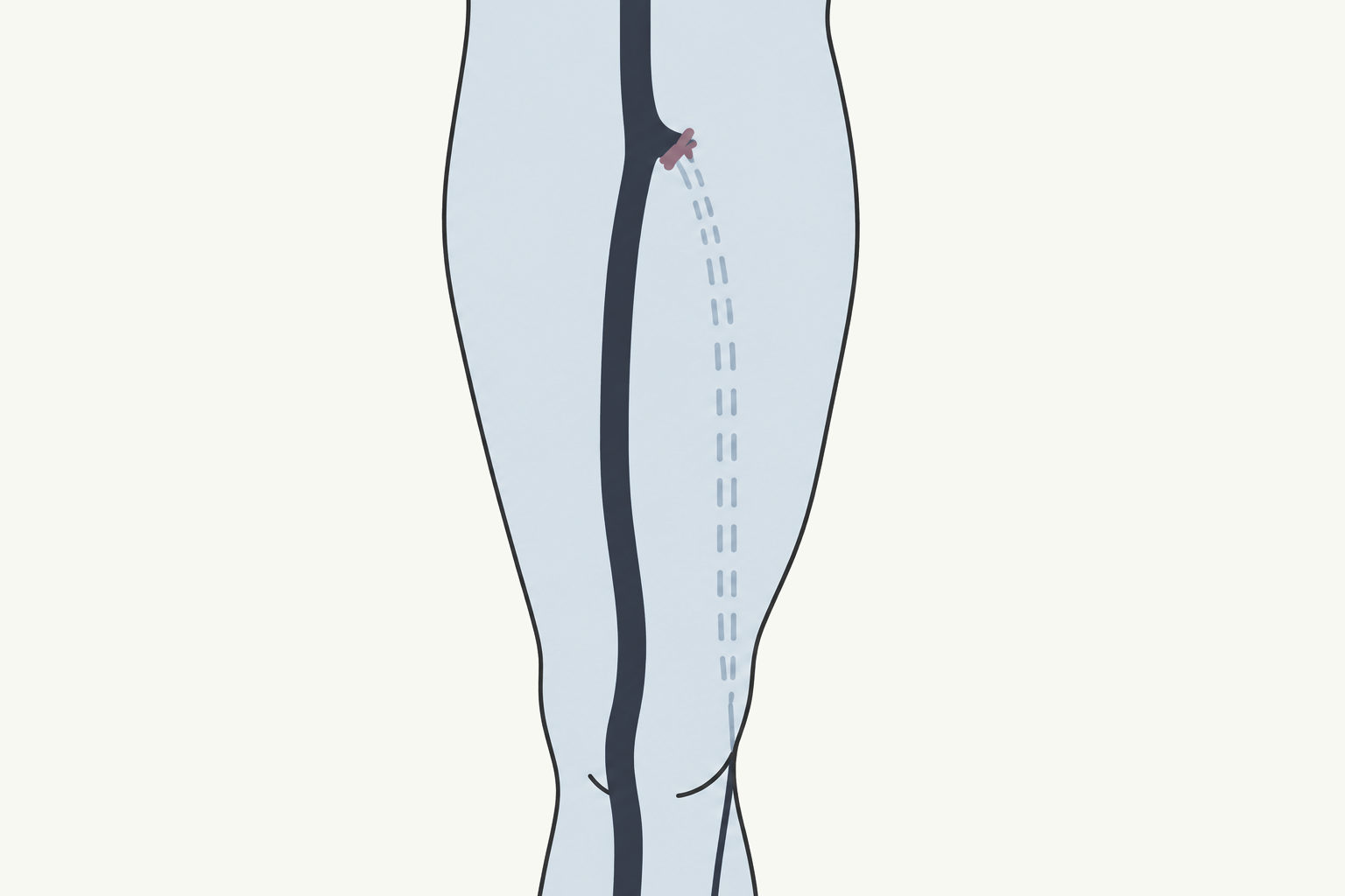 Drawing, not to scale: a leg vein tied off where it joins the deep vein at the groin, and removed down to the knee