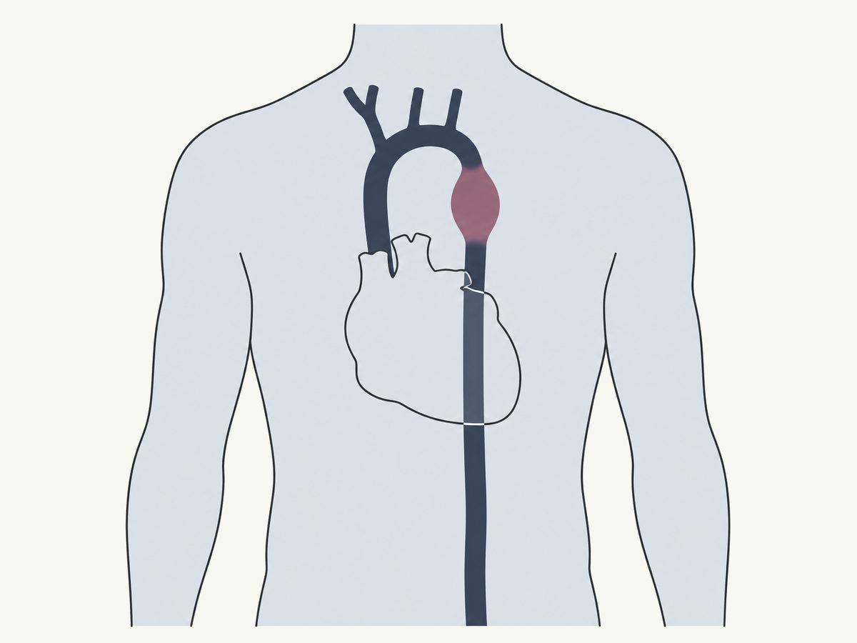 Drawing, not to scale: the aorta in the chest with one section widened just below the arch, the rest running down behind the heart