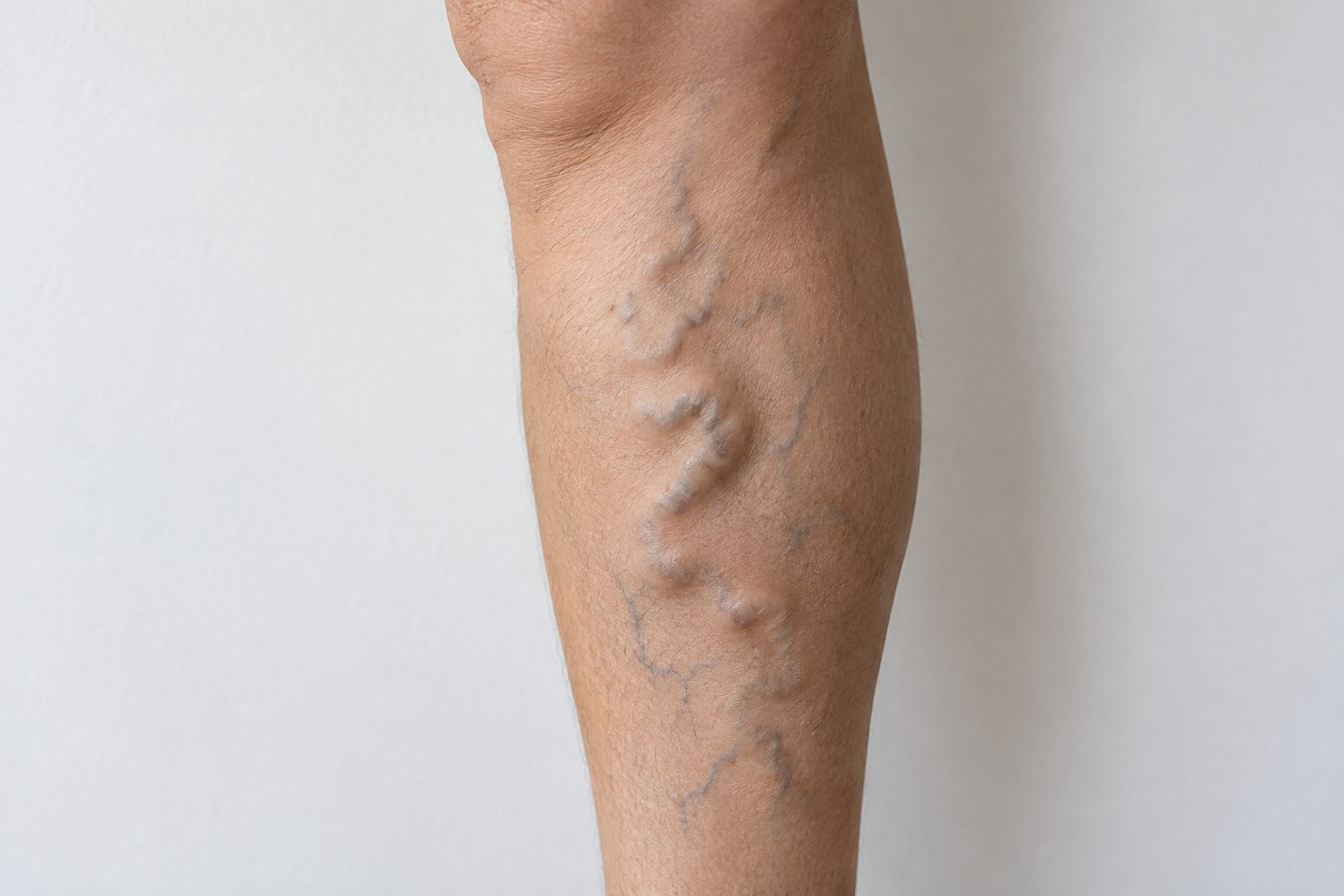 Close view of bulging varicose veins on a calf
