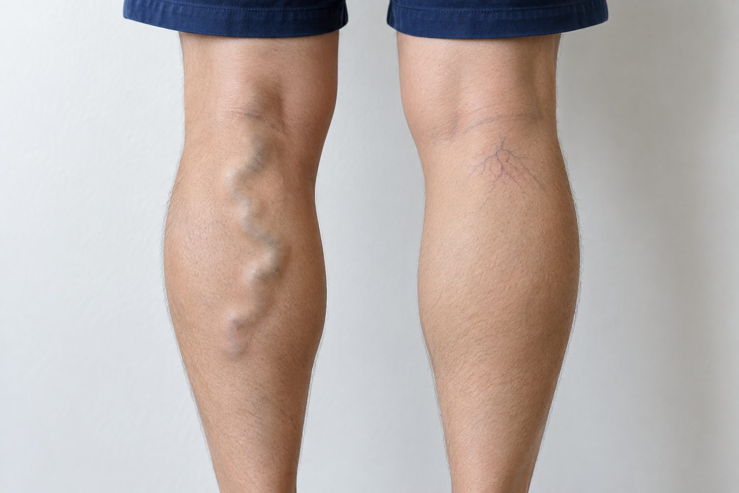 A raised, twisting varicose vein down the back of one calf