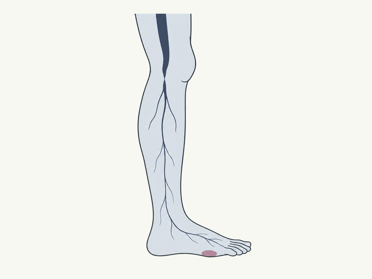 Drawing, not to scale: a narrowed leg artery and thin blood flow to the foot
